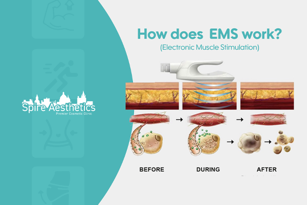 EMS treatment for post pregnancy weight loss treatment Benson