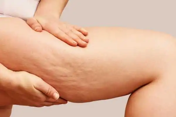 Image of woman showing leg with cellulite Benson