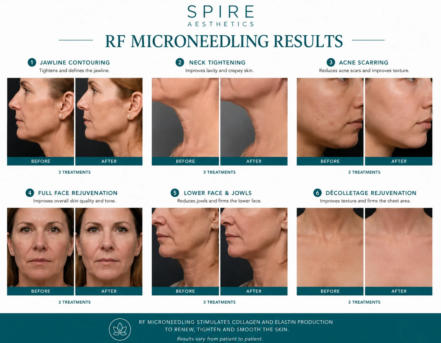 RF Microneedling Skin tightening Benson results