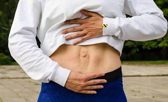When Could Diastasis Recti Be the Missing Piece of the Puzzle Benson?