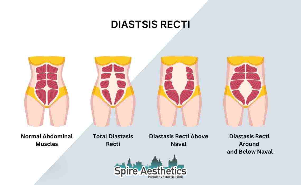 Is Non-Surgical Diastasis Recti Treatment Right for You? Common Concerns Answered Benson